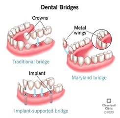 An illustration showing three types of dental bridges: Traditional bridge with crowns, Maryland bridge with metal wings, and Implant-supported bridge with dental implants - Morris Family Dentistry An illustration showing three types of dental bridges: Traditional bridge with crowns, Maryland bridge with metal wings, and Implant-supported bridge with dental implants - Morris Family Dentistry